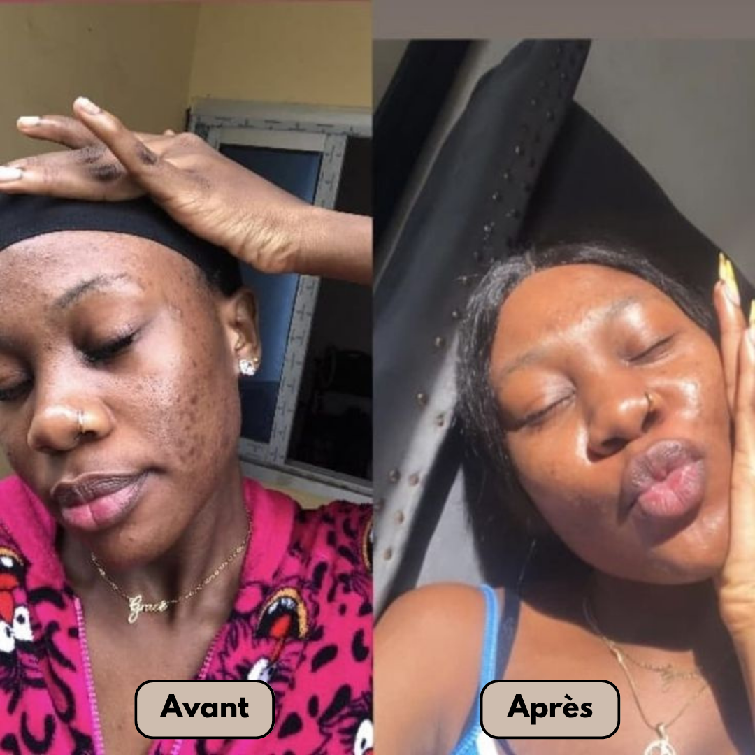 Noraske™ GlowBar – Savon Visage & Corps au Curcuma